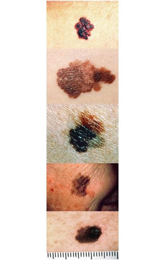 A column of pictures showing examples of the ABCDEs of melanoma